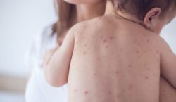 NanoViricides’ Measles Treatment Granted Orphan Drug Designation by FDA