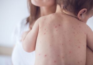 NanoViricides’ Measles Treatment Granted Orphan Drug Designation by FDA