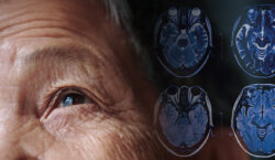 Real Parkinson’s Disease Hope from Jupiter Neurosciences