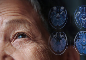 Real Parkinson’s Disease Hope from Jupiter Neurosciences